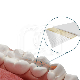 DENTAPREG SFU SINGLE (6CM)