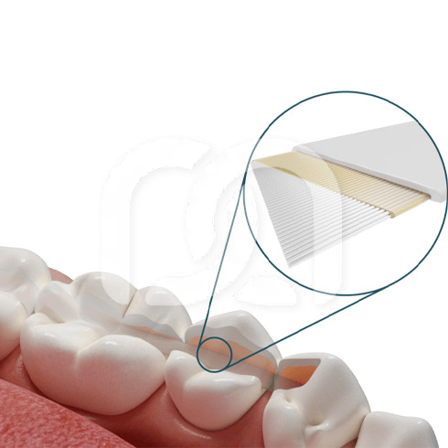 DENTAPREG SFU SINGLE (6CM)