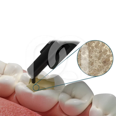 FIBRAFILL DENTIN (20)