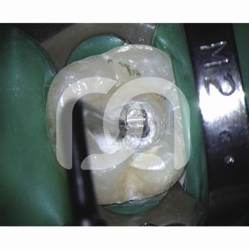 INSERTS START-X - INSERT NÂ°1 COMPATIBLE SATELEC