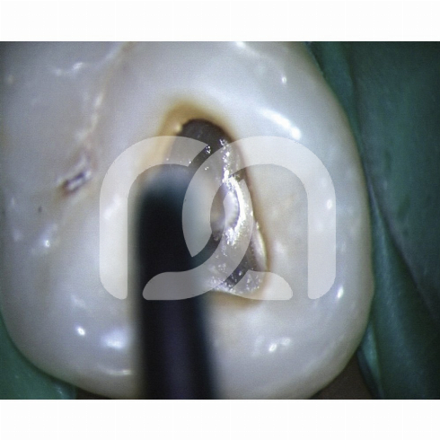 INSERTS START-X - INSERT NÂ°1 COMPATIBLE SATELEC