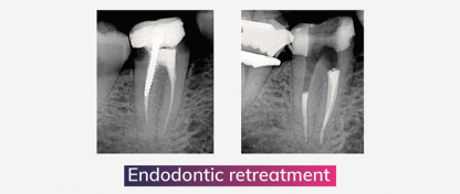 HUGO SETBON : ENDODONTISCHE HERBEHANDELING