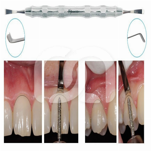 DUBBELZIJDIGE GINGIPROTECT-INSTRUMENT 3,7MM DUBBELZIJDIGE GINGIPROTECT-INSTRUMENT 3,7MM