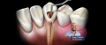 Comment bien choisir sa lime endodontique ?