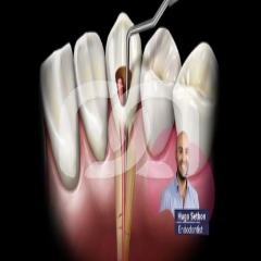 Comment bien choisir sa lime endodontique ? Comment bien choisir sa lime endodontique ?