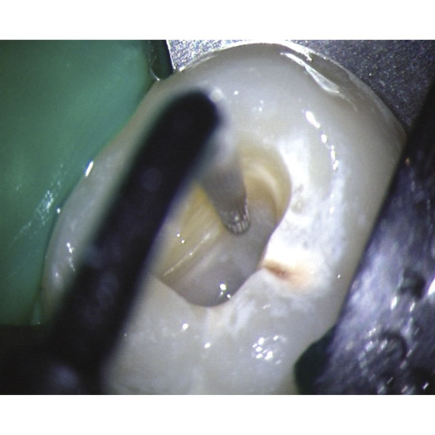 INSERTS START-X - INSERT NÂ°1 COMPATIBLE SATELEC